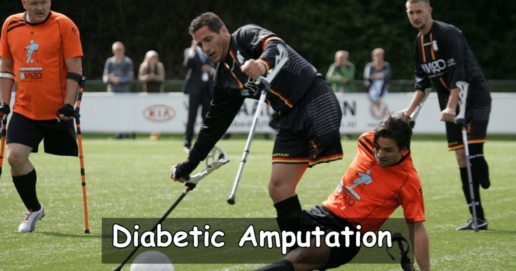 Diabetic Amputation